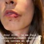 Marion hield er een kapotte lip aan over. 